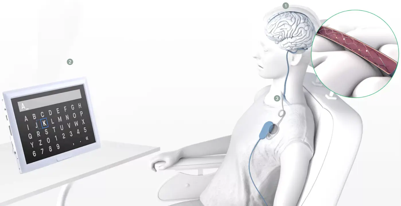 Fully Invasive Brain Computer Interface Synchron: Overcoming Neurological Disorders Through Technology - Alumni ...